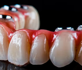 Estructuras implantológicas metal cerámica