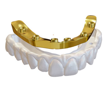 Composición de prótesis dentales que muestra una estructura de titanio fresado anodizado dorado sobre una arcada de zirconio multicapa, junto a ejemplos de puentes dentales terminado