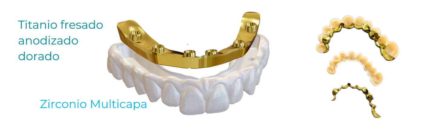 Composición de prótesis dentales que muestra una estructura de titanio fresado anodizado dorado sobre una arcada de zirconio multicapa, junto a ejemplos de puentes dentales terminado
